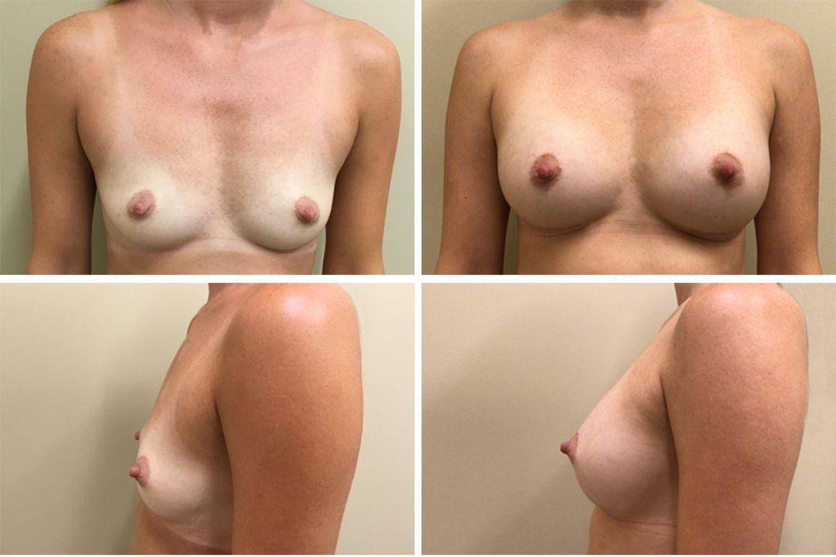 before and after photos of breast augmentation surgery 34 year old female with 330 cc smooth implants