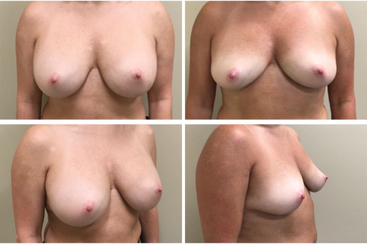 before and after front and side view photos of 51 year old female 3 months post op breast implant removal surgery