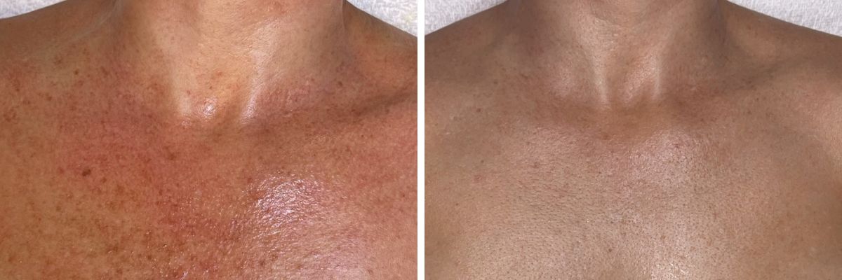 female before and after EVO IPL treatments on chest