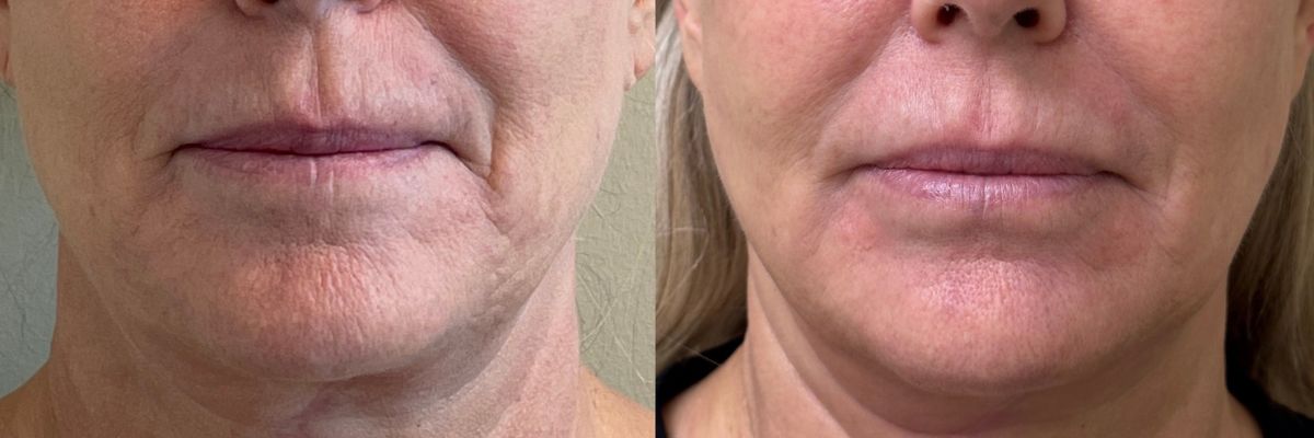 female before and after EVO Elluminate treatments