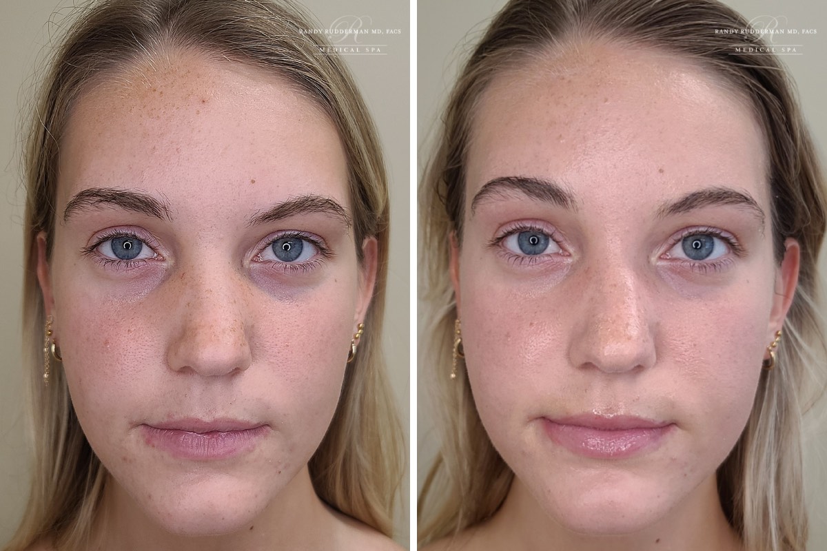 Before and after hydrfacial 24 year old female patient
