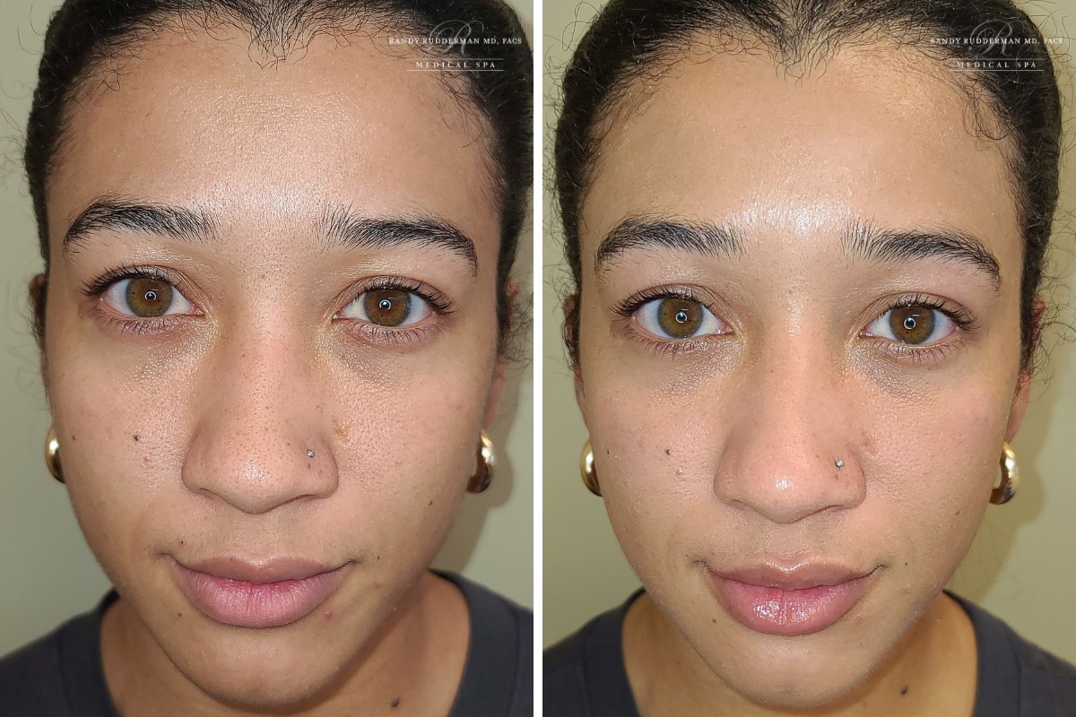 23 year old female before and after HydraFacial treatment
