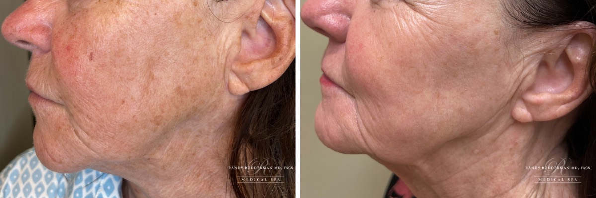 before and after photo of 67 year old female who received Elluminate EVO light treatment