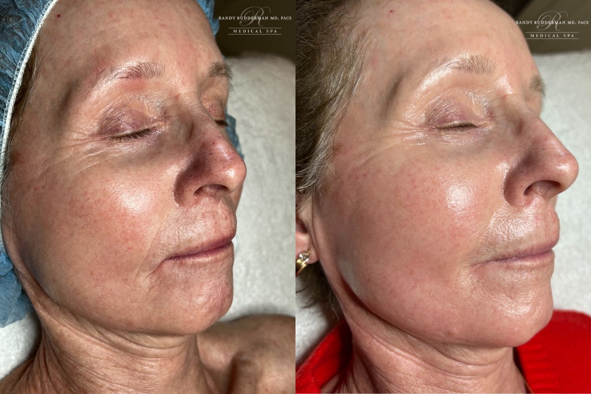 female before and after photo right after dermaplane and hydrafacial treatment