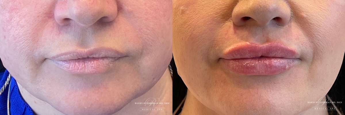 femalebefore after 1cc-vollure 1cc kysse lip filler