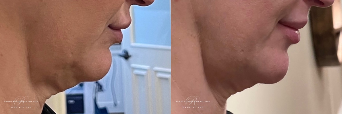 female before and after microtox treatment on chin right side view