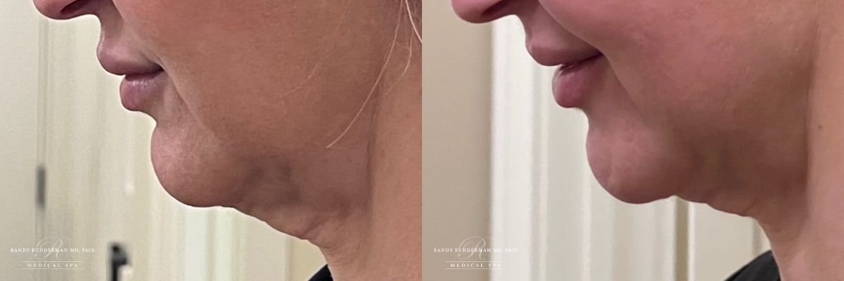 female before and after microtox treatment on chin left side view