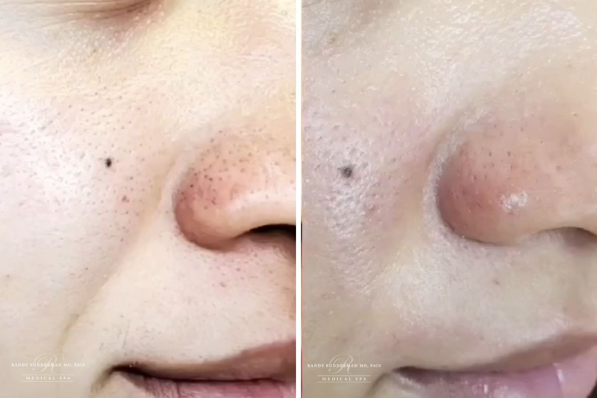 female before and after blackheads from hydrafacial treatment