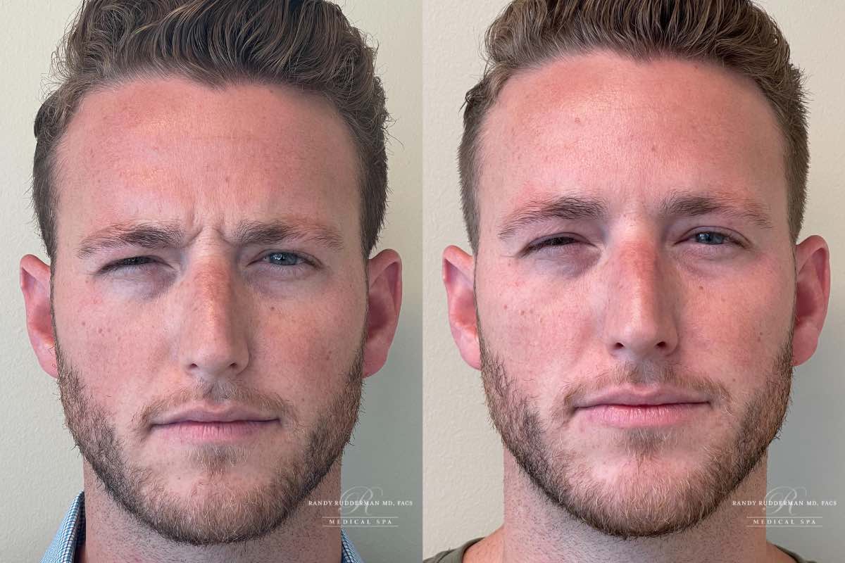 male before and after Botox treatment on forehead
