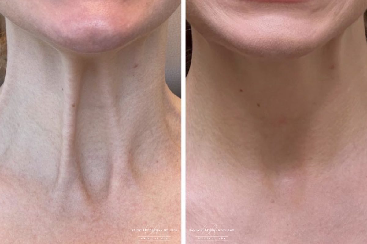 female before and after filler injection to treat platysma neck