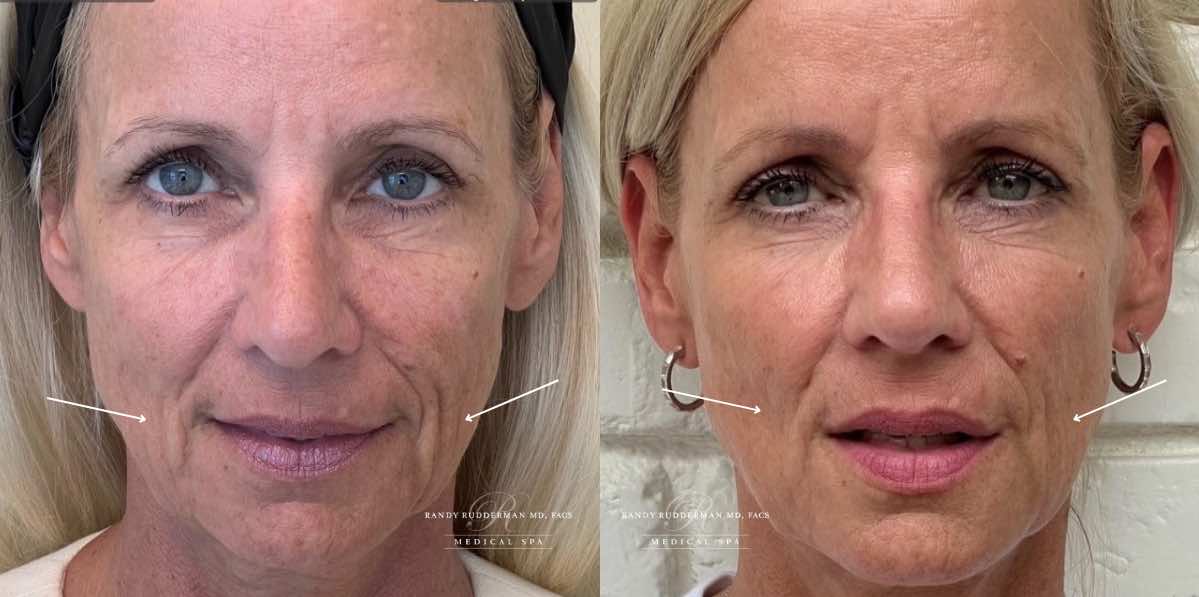 female before and after Botox for jawline front view