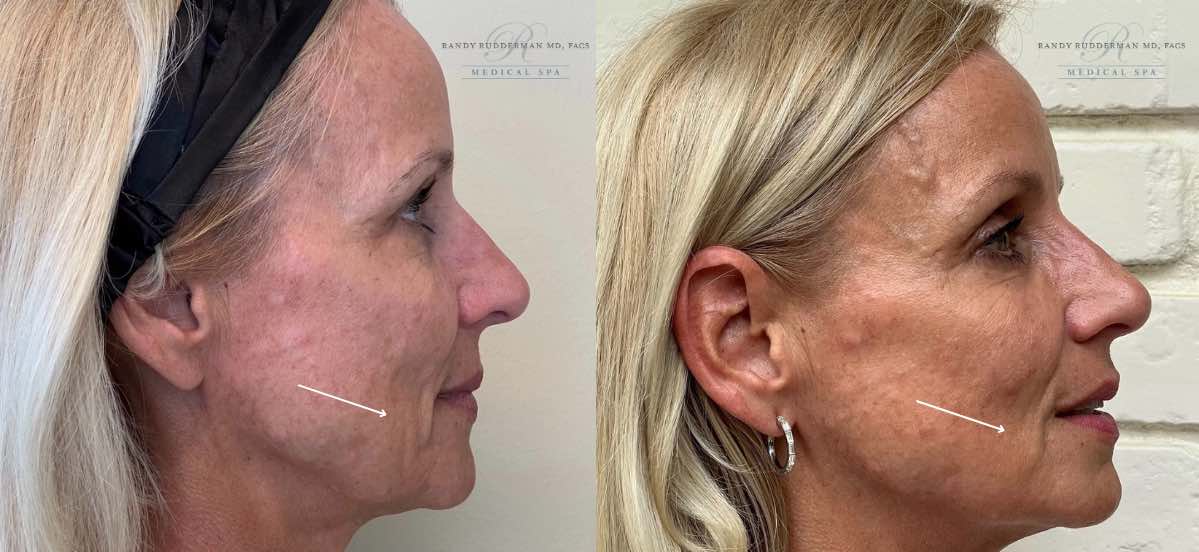female before and after Botox for jawline side view