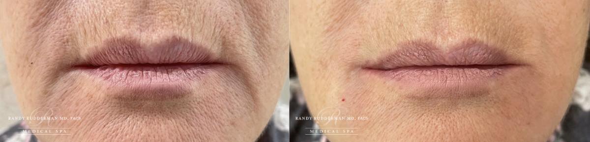 female before and after photo restylane filler to treat marionette lines