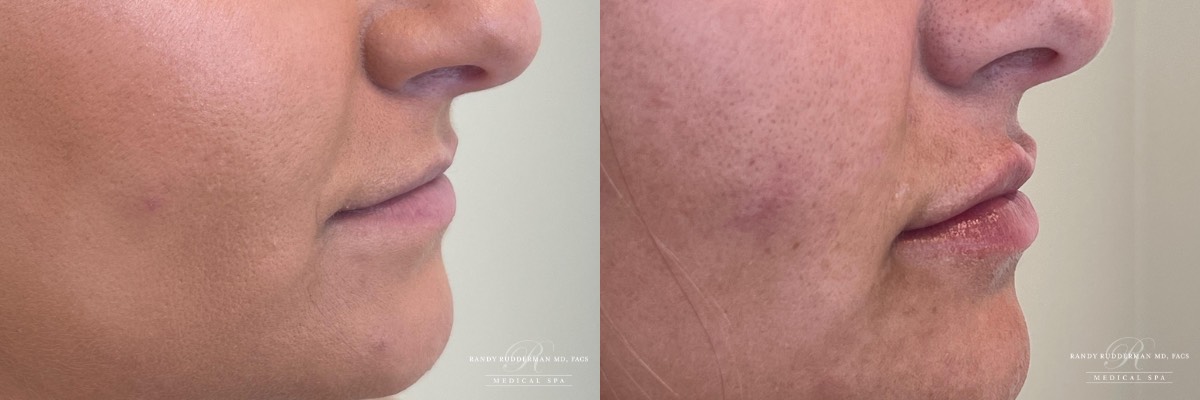 female before after side view vollure lip filler