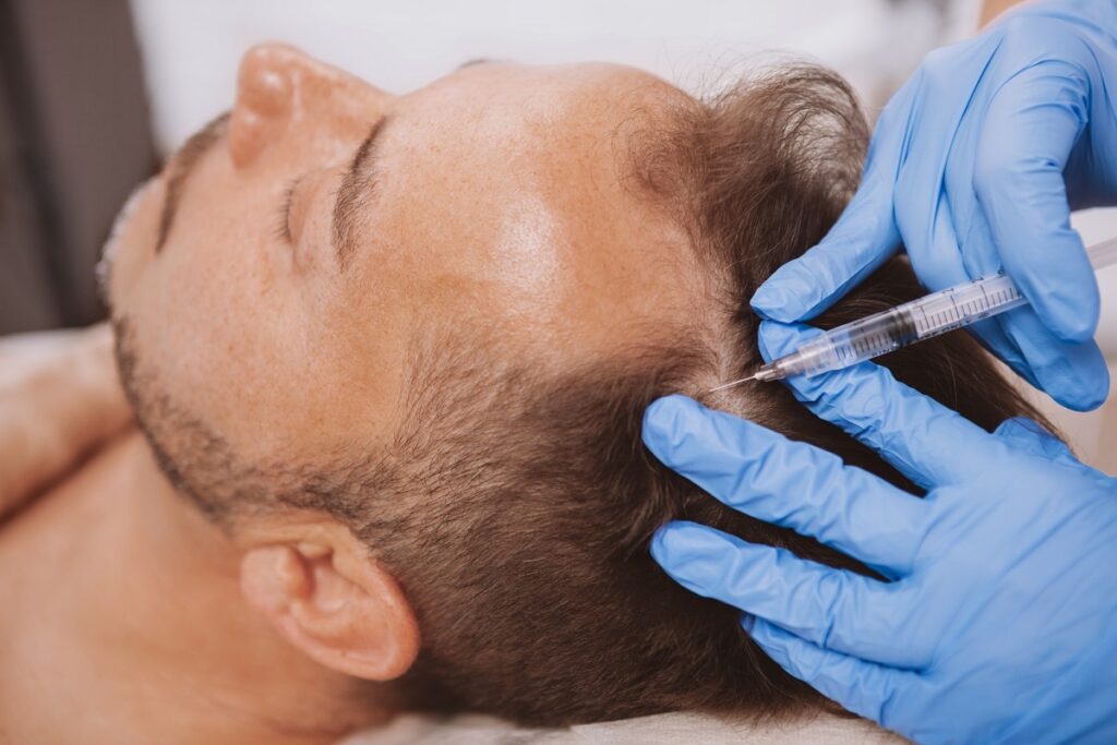 male getting PRP injection on top of head