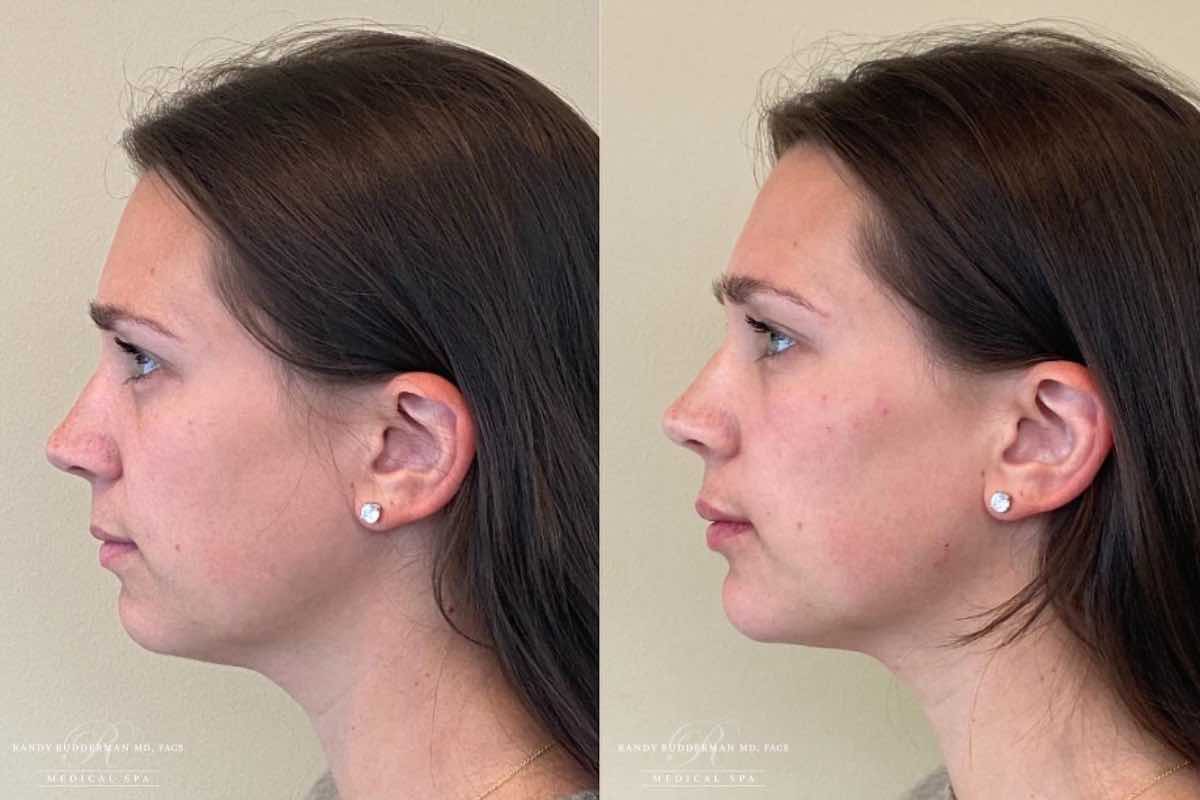 female before and after Juvederm injections to chin, cheeks and lips.
