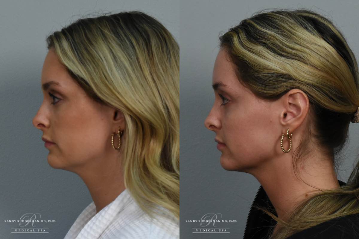 female before and after Kybella injection to the submentum left side view