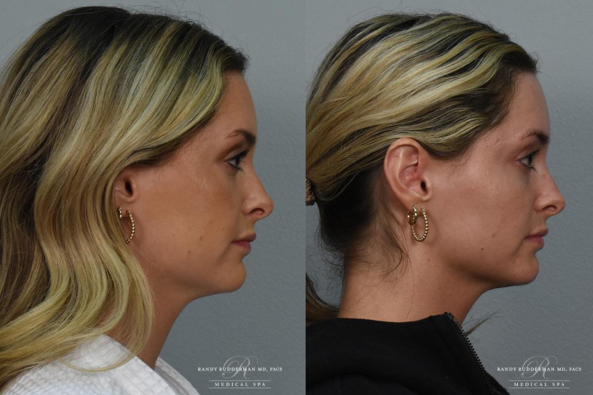 female before and after Kybella injection to the submentum right side view