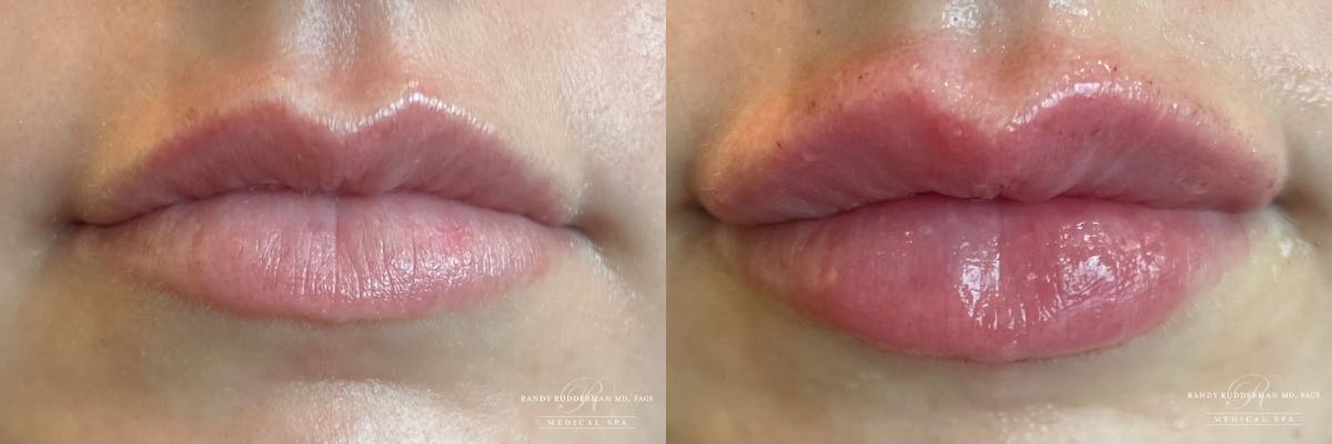 female before and after Restylane Kysse lip filler