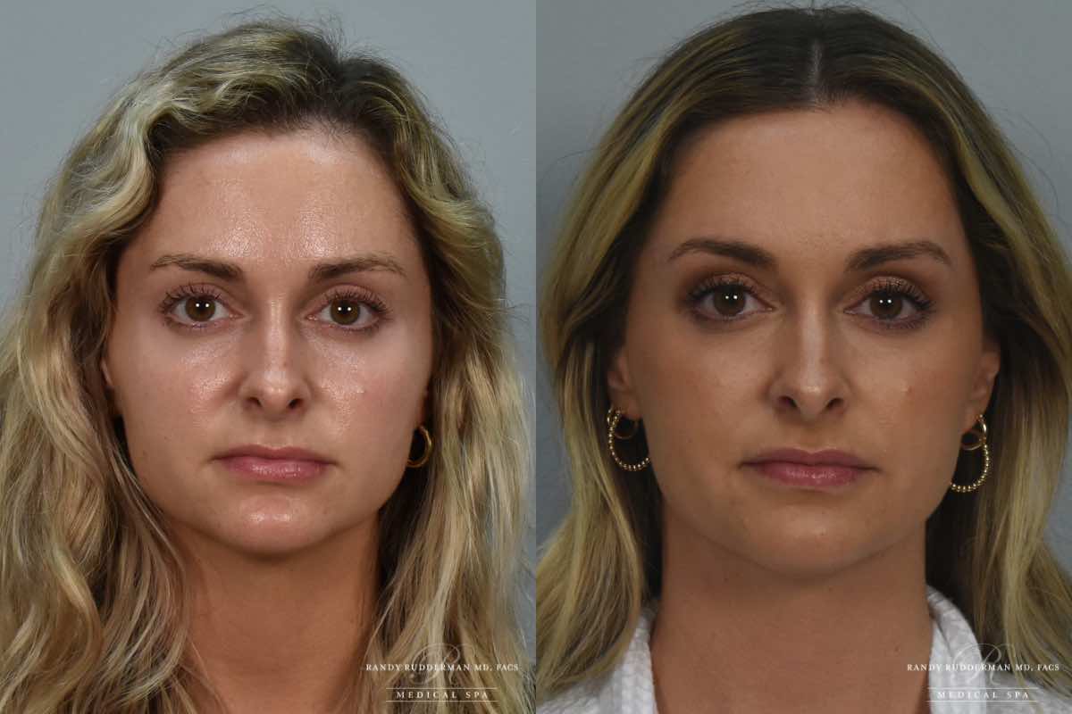 female before and after Juvederm Vollure fillers to the lips
