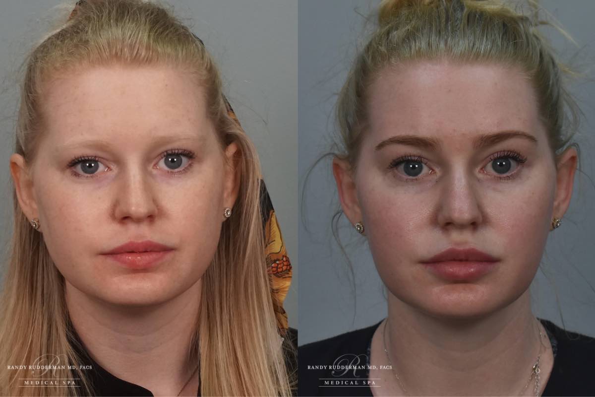 female before and after photos of full face balancing with fillers and botox
