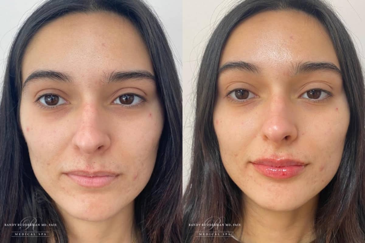 Female before and after Restylane Kysse filler photo