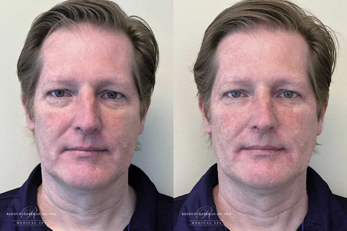 male before and after facial fillers