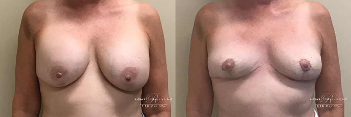 Breast implant removal, total capsulectomy and lift before and after front view