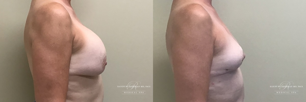 Breast implant removal, total capsulectomy and lift before and after side view