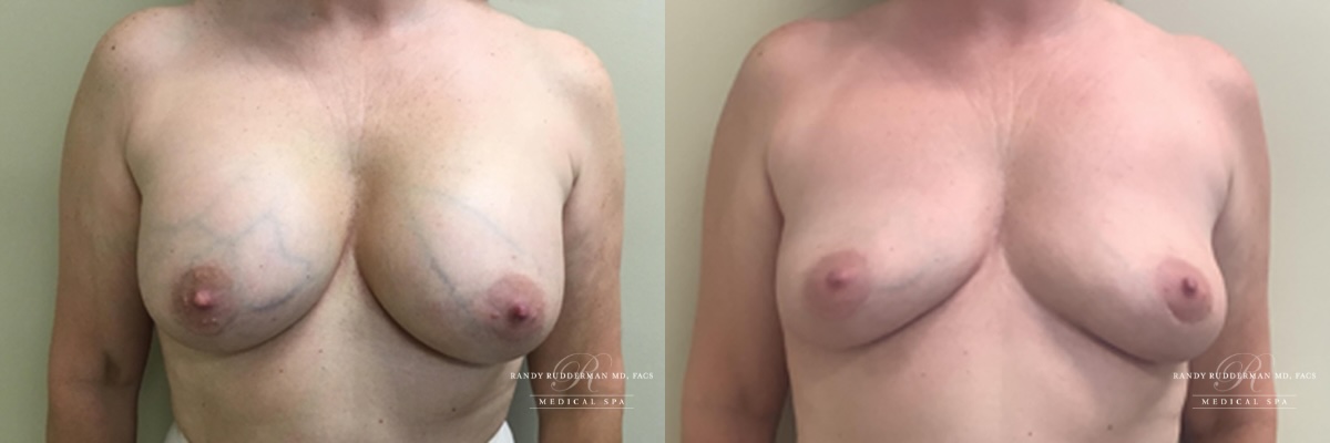 breast implant removal and total capsulectomy before and after 49 yr old female front view