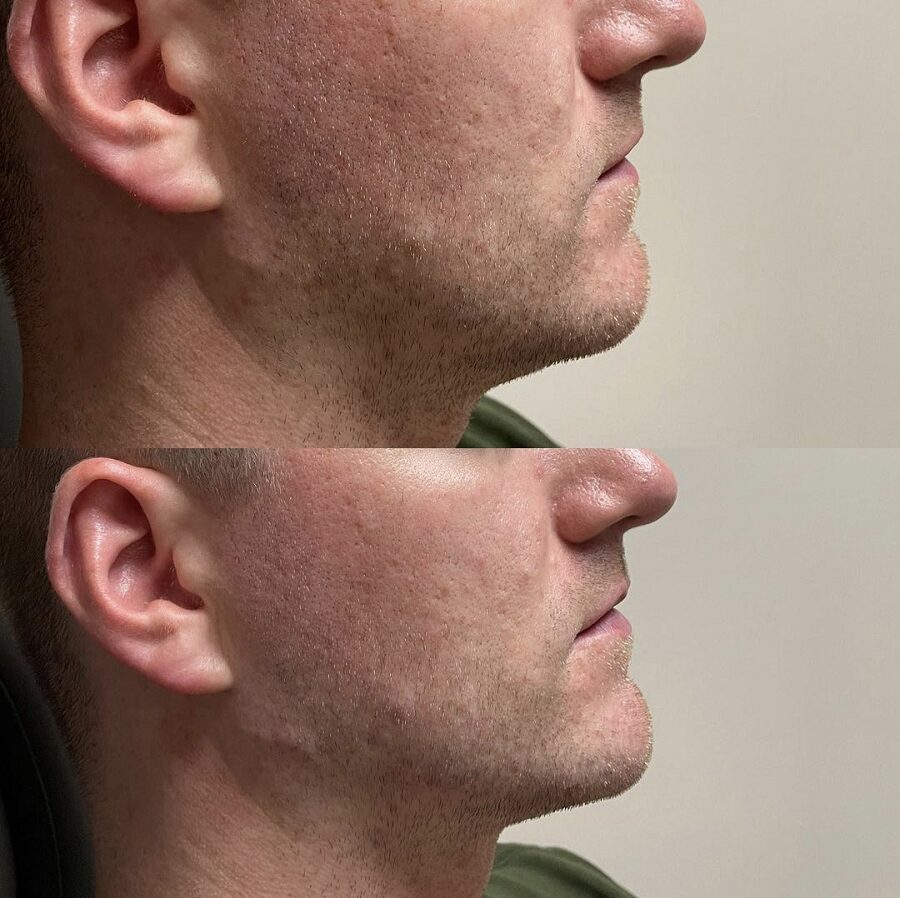 Man treated with filler for jaw and chin enhancement