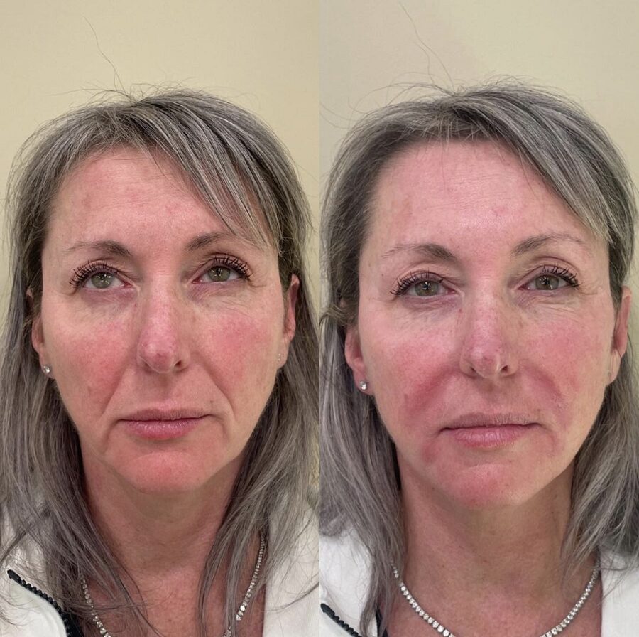 Woman in her 50s showcasing a Nasolabial Folds treatment