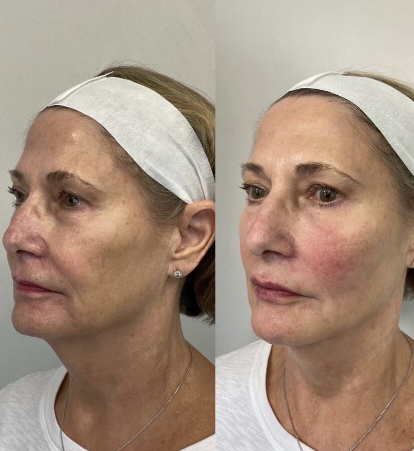 Woman in her 60s treated for skin laxity