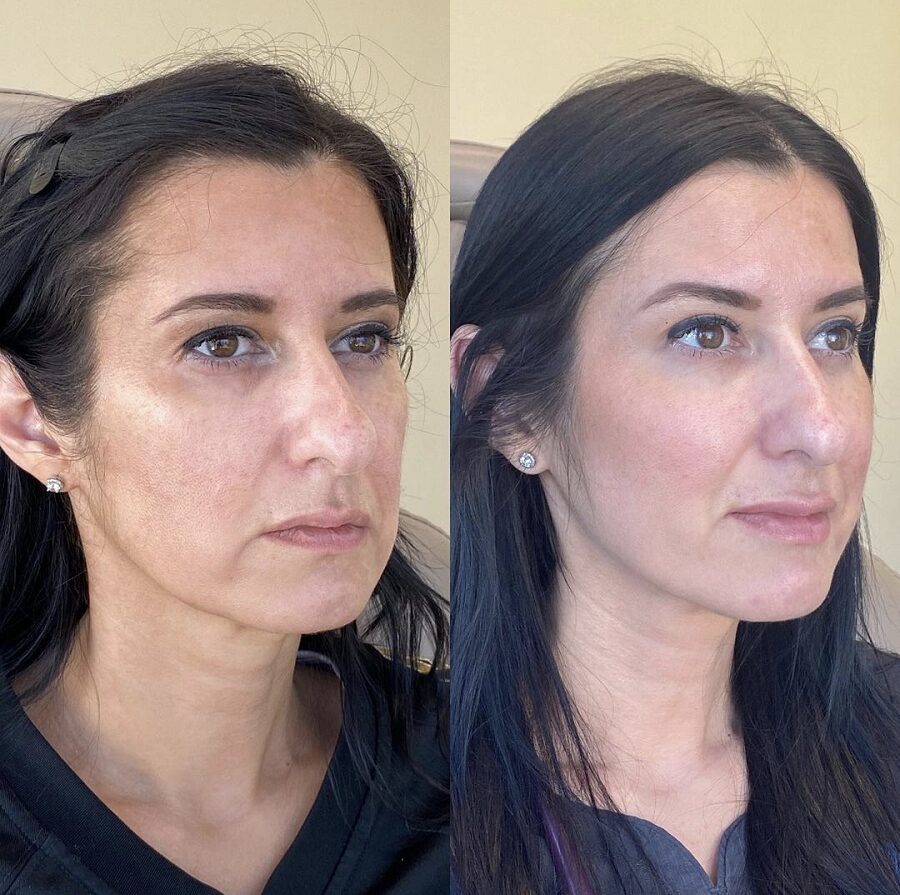 Woman in her 40s treated with fillers and wrinkle relaxers