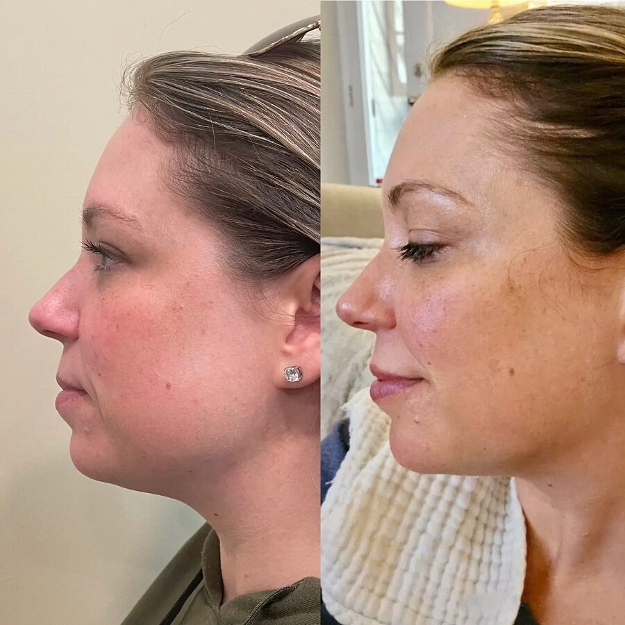 Facial Balancing on a woman in her 30s using fillers