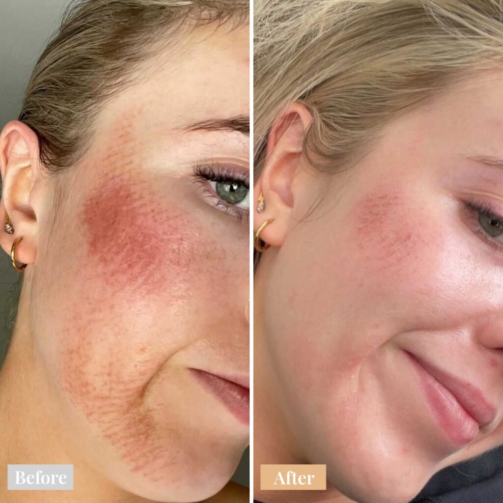 female before and after Omnilux Face mask, redness on cheeks and jaw
