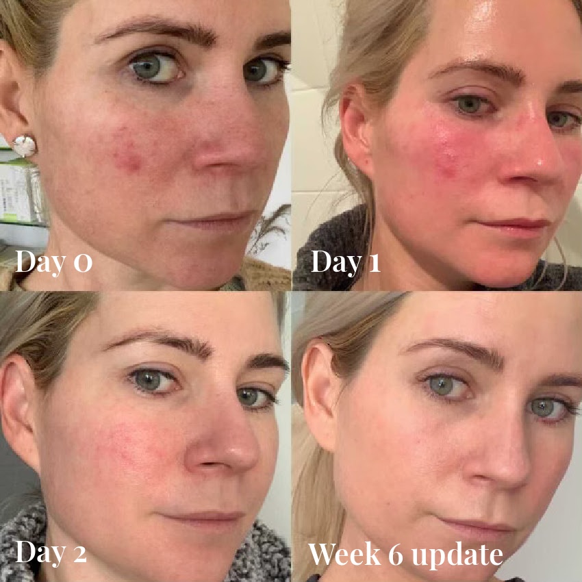female before and after Omnilux Face mask, acne on cheeks, 6 week update