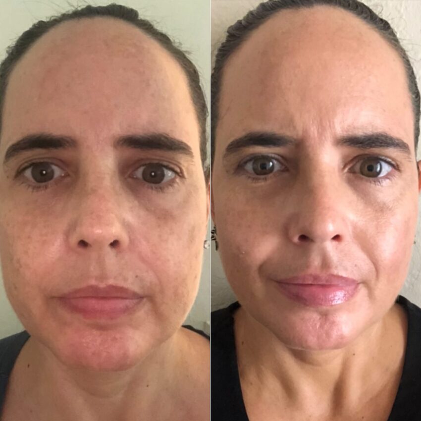 female before and after Omnilux Face mask, pigmentation on face
