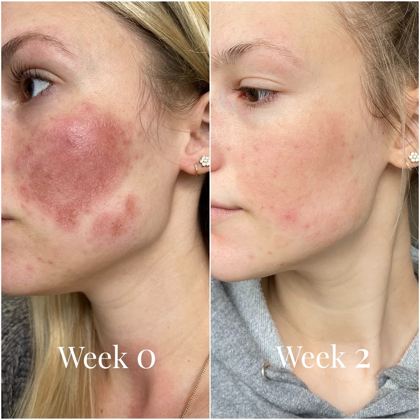female before and after Omnilux Face mask, redness and acne on face