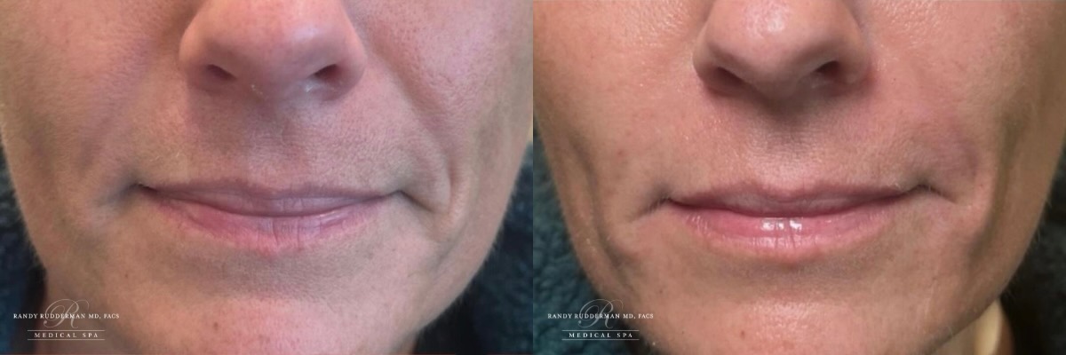 female before and after RHA2 dermal fillers for smile lines