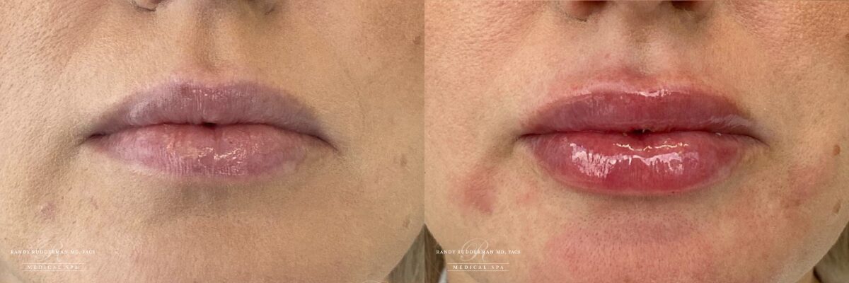 Female before and after lip filler