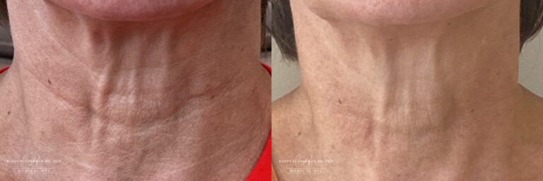 Female before and after microtox for neck lines