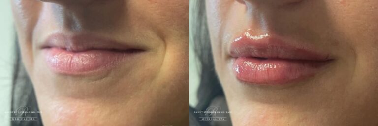 Restylane Kysse before and after lip filler 1 year post treatment