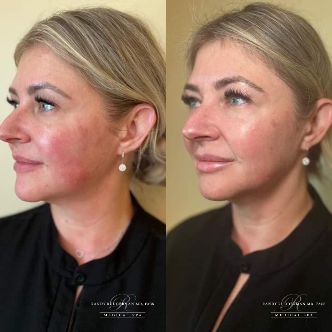 Skinvive Female before and after side view