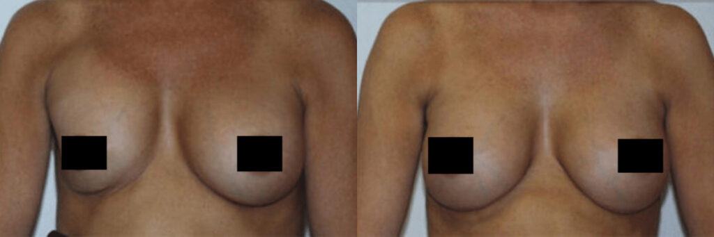 before and after capsular contracture patient