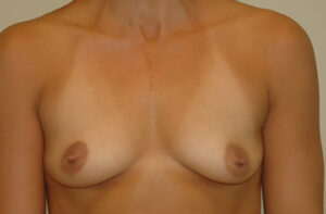 Breasts before breast asymmetry correction, front view — Dr. Rudderman, Atlanta.
