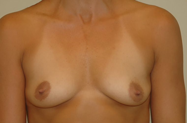 Breasts before breast asymmetry correction, front view — Dr. Rudderman, Atlanta.