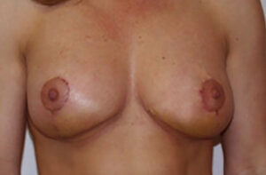 Breasts after breast asymmetry correction, front view — Dr. Rudderman, Atlanta.