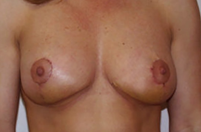 Breasts after breast asymmetry correction, front view — Dr. Rudderman, Atlanta.