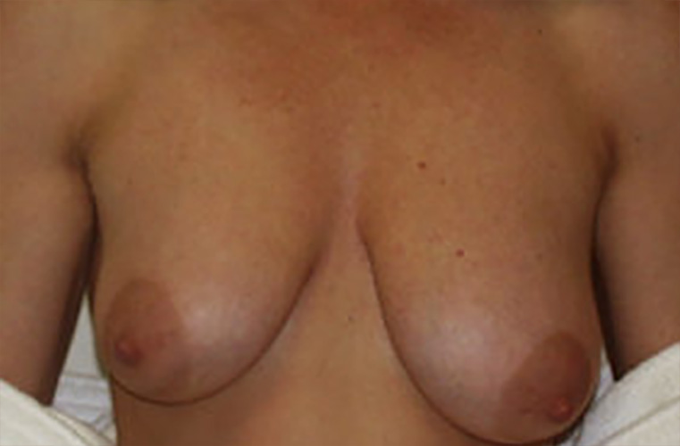 Breasts before breast asymmetry correction, front view — Dr. Rudderman, Atlanta.